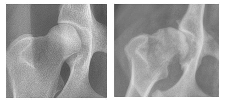 Hüfte mit und ohne Arthrose